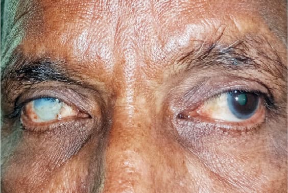 Beyond Free Screening: Nigeria’s Search For Sustainable Eye-Care Funding